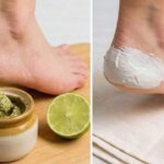 Quick Ways to Heal Dry Cracked Heels at Home Using Safe and Effective Kitchen Ingredients